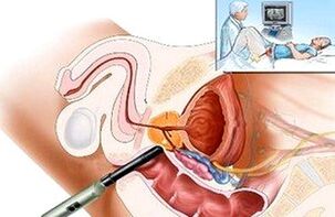 maneiras de diagnosticar prostatite