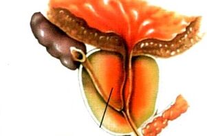 o que é prostatite em homens