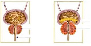 tipos e formas de prostatite em homens