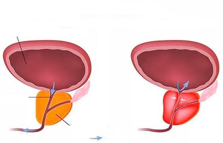 próstata normal e inflamada