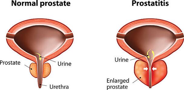 próstata normal e inflamada