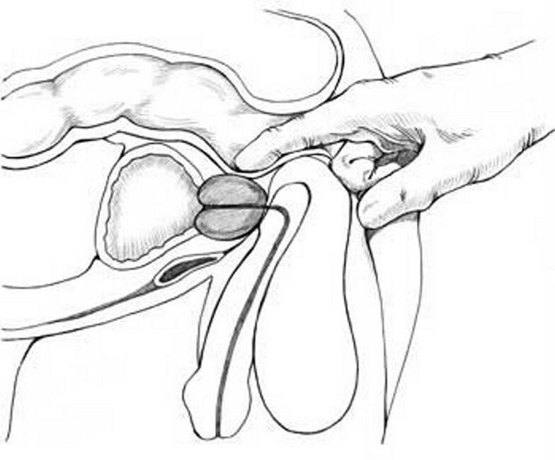 massagem de próstata para prostatite crônica