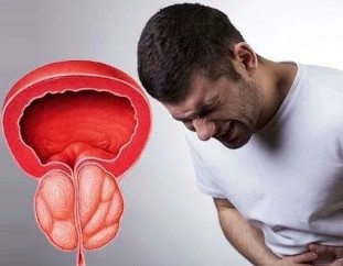 Os sintomas da prostatite crónica em homens