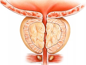 A prostatite