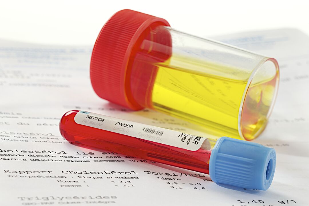 Um exame de sangue e urina ajudará a determinar a presença de prostatite.